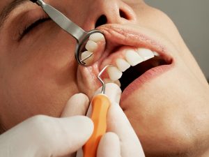 Gum Disease and Periodontal Therapy